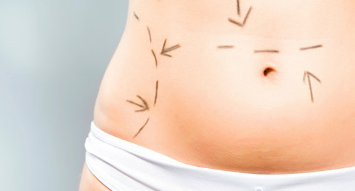 liposuccion-essentiel-main-3314642